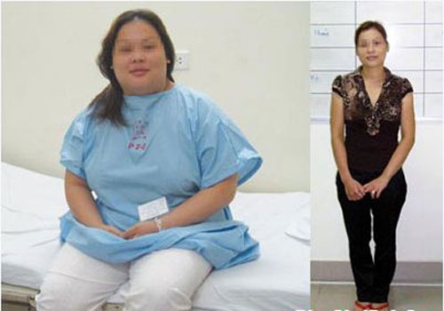 Thắt[-]đai[-]dạ[-]d&agrave;y[-]giảm[-]b&eacute;o:[-]hiệu[-]quả[-]gấp[-]10[-]lần[-]phương[-]ph&aacute;p[-]kh&aacute;c[-]2